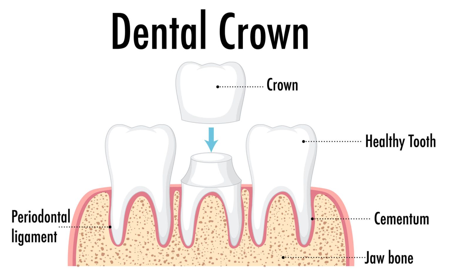 Dental crown anatomy diagram: a crown hovering above a prepared tooth with adjacent healthy teeth, labeled parts showing the crown, healthy tooth, cementum, periodontal ligament, and jaw bone.