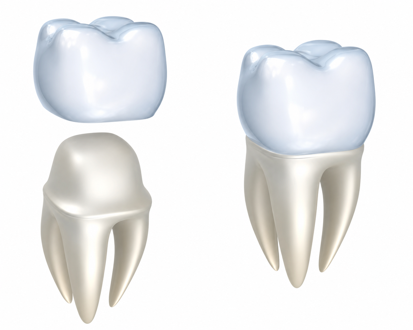 Diagram of a restored tooth showing the crown, remaining tooth, and supporting structures
