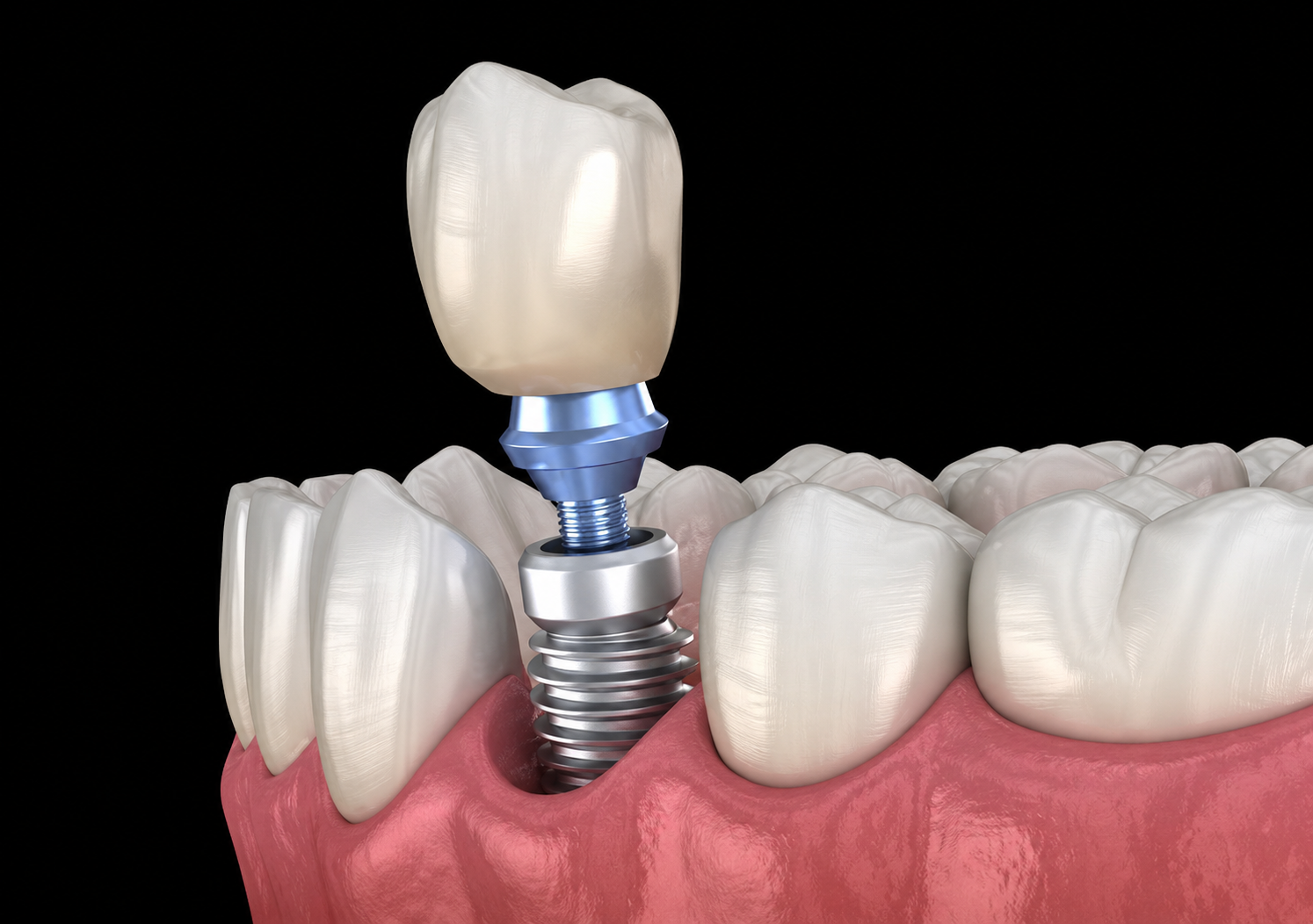 3D render on a dark background showing the three parts of a dental implant — ceramic crown, metal abutment, and titanium screw — displayed separately above the gum line.