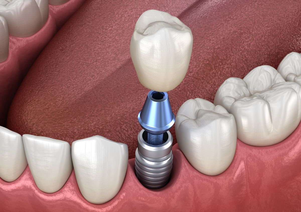 3D render of a dental implant being placed: titanium post in jaw bone, abutment connector, and ceramic crown lowering into position