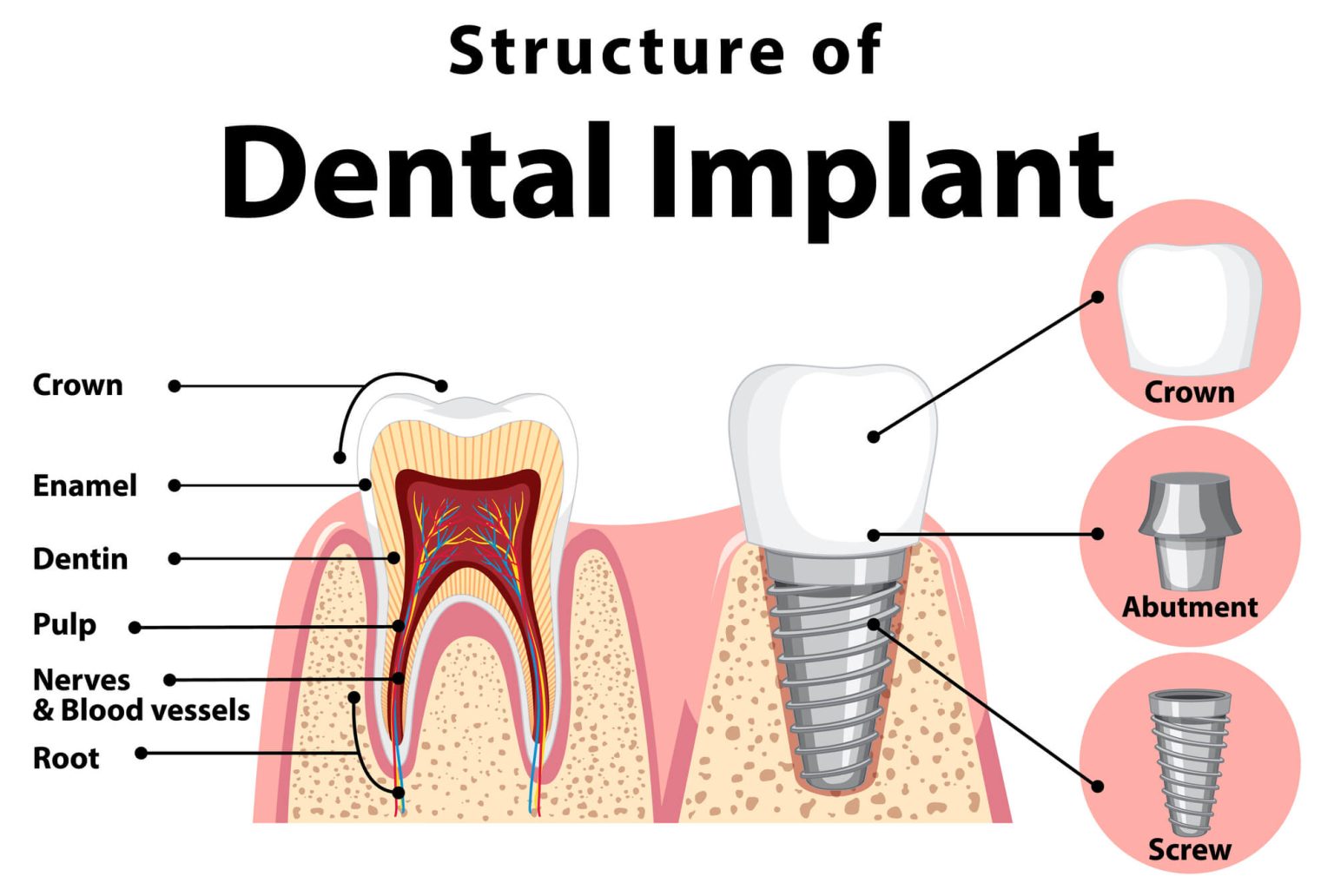 Structure of a dental implant diagram: cross-section of natural tooth anatomy alongside implant showing the threaded titanium screw anchored in jaw bone, metal abutment connector, and ceramic crown on top — with callout circles labeling the crown, abutment, and screw.