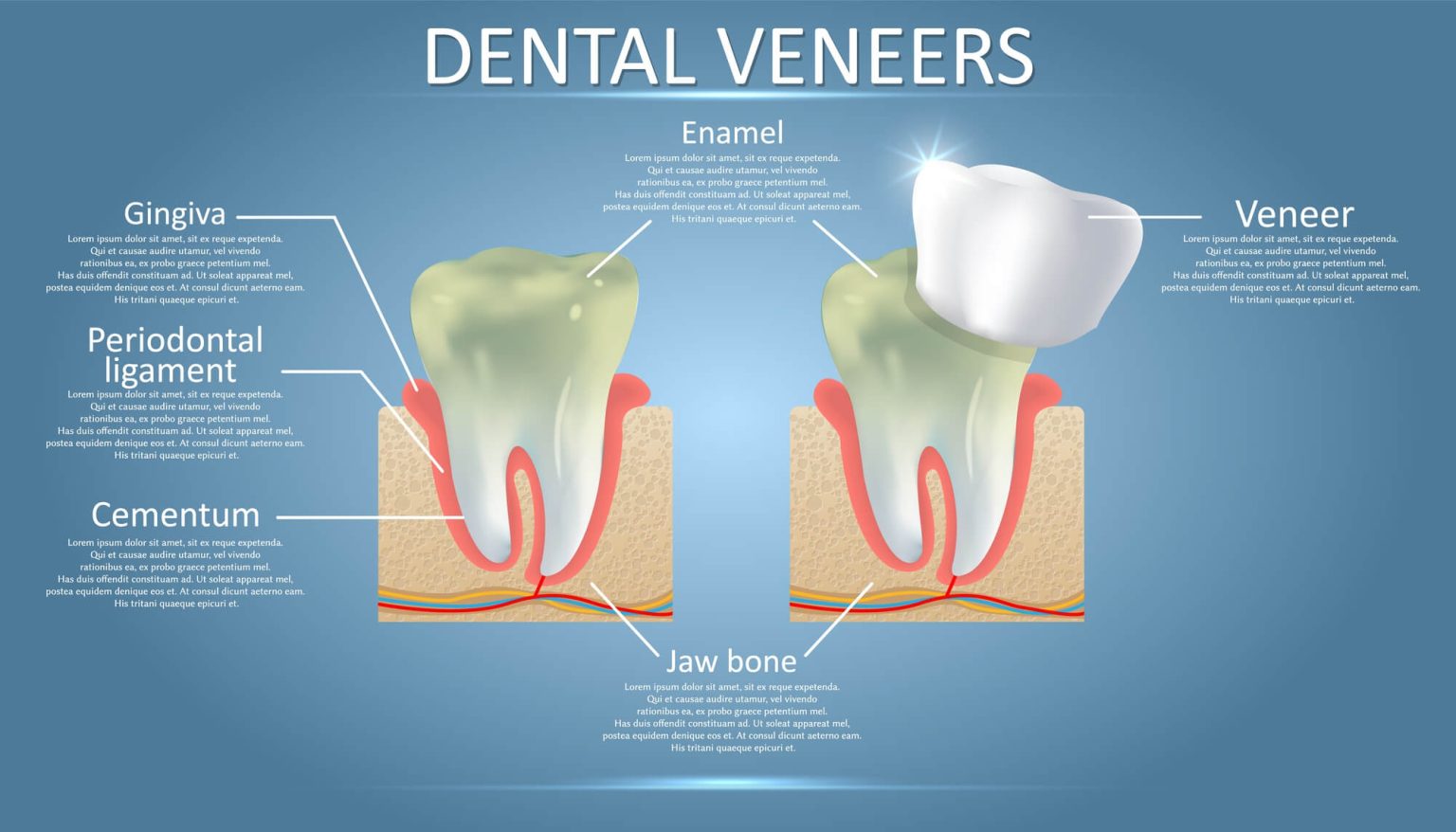 Dental veneers anatomy: tooth cross-section labels and a porcelain veneer being placed on the front surface