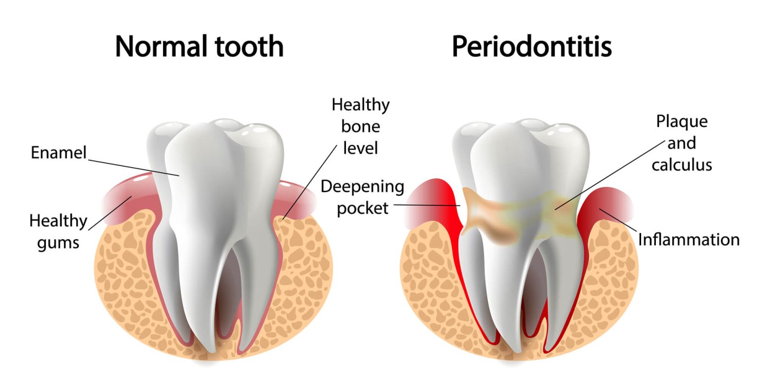 Side-by-side comparison of a healthy tooth and gums versus periodontitis with a deeper pocket and inflammation
