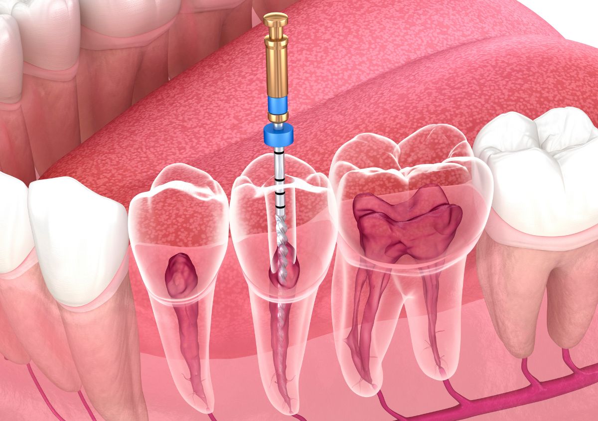 3D transparent view of a molar during root canal treatment: an endodontic file on a precision handpiece entering the crown, cleaning infected pulp from the canal of one tooth while adjacent teeth show their internal canal anatomy.