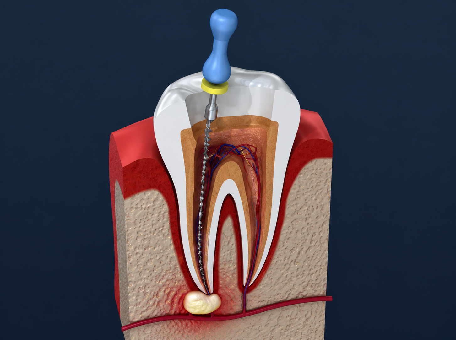 3D cutaway illustration of a single tooth showing an endodontic file cleaning inside the root canal, with an infection visible at the root tip indicating why treatment is needed.