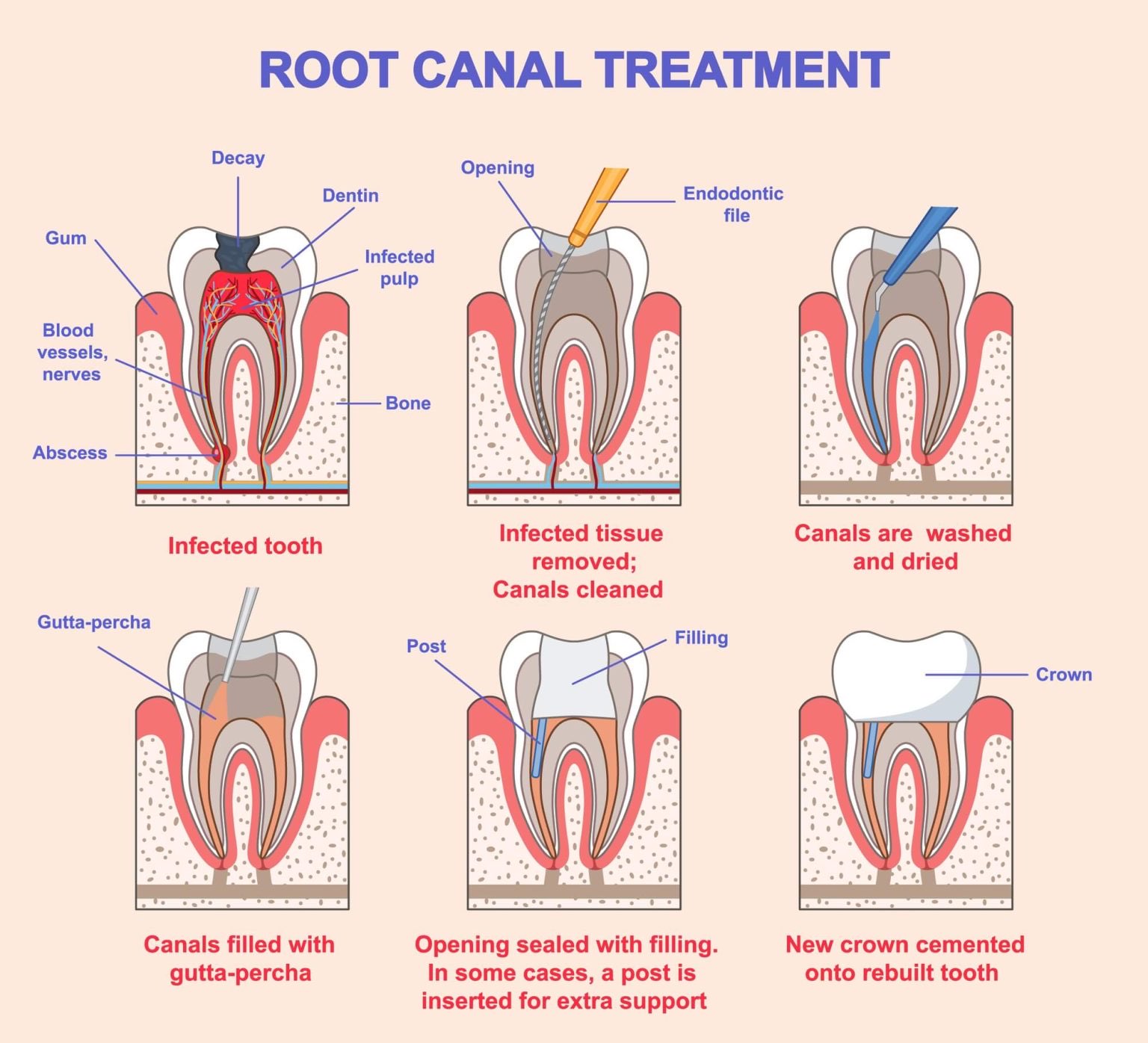 Root canal treatment six-step infographic: infected tooth with abscess, infected tissue removed and canals cleaned, canals washed and dried, gutta-percha filling inserted, opening sealed with filling and post, new crown cemented onto rebuilt tooth.