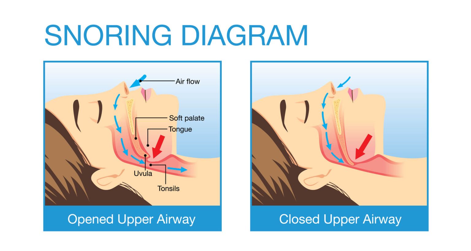Diagram comparing an open airway versus a collapsed airway during sleep