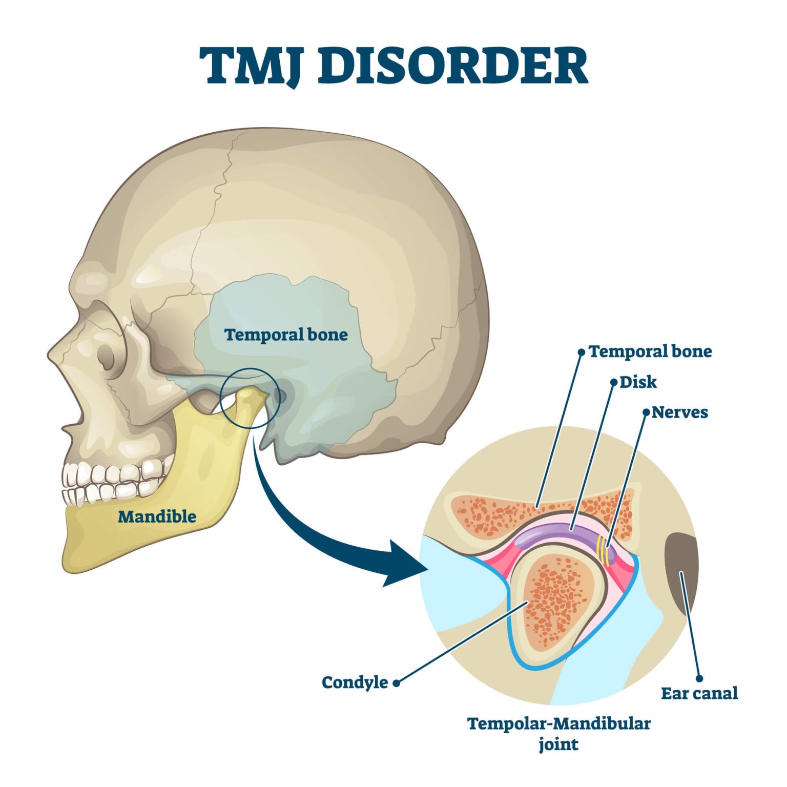 Diagram of the temporomandibular joint showing the jaw, disk, and surrounding structures