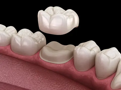 3D illustration showing a ceramic crown being placed onto a prepared tooth