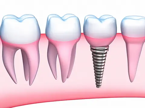 3D illustration of a dental implant post positioned between natural teeth in the arch