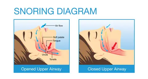 Diagram comparing an open airway versus a collapsed airway during sleep