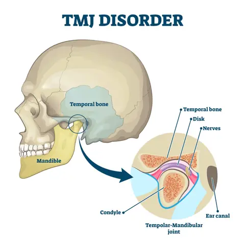 Diagram of the temporomandibular joint showing the jaw, disk, and surrounding structures