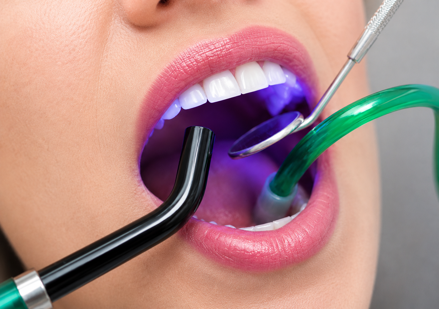 Close-up of an open mouth during a dental laser procedure, showing the curing light and instruments in position.