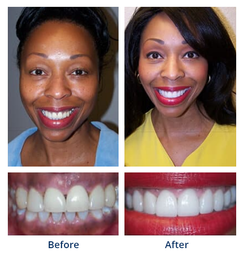 Before-and-after smile gallery case 6 with full-face and close-up smile photos
