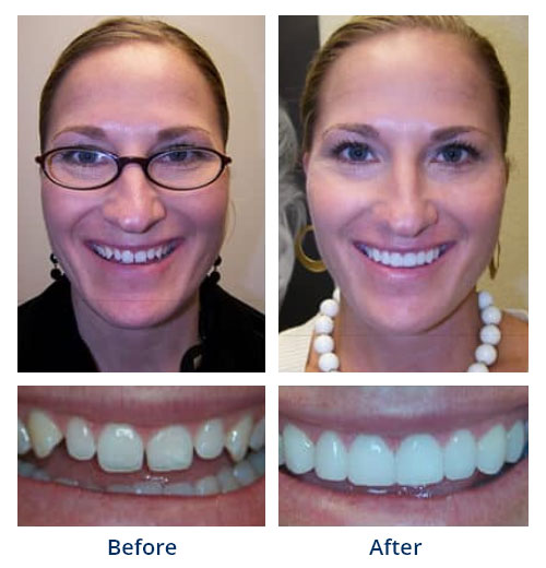 Before-and-after smile gallery case 4 with full-face and close-up smile photos
