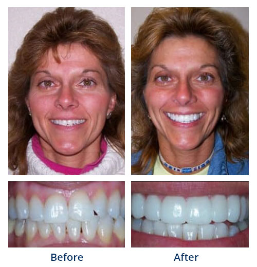Before-and-after smile gallery case 3 with full-face and close-up smile photos