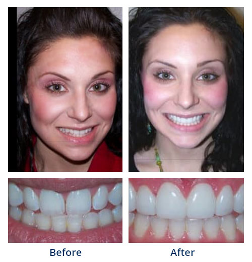 Before-and-after smile gallery case 8 with full-face and close-up smile photos