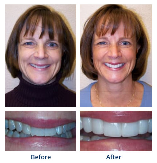Before-and-after smile gallery case 1 with full-face and close-up smile photos