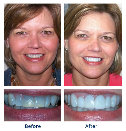 Before-and-after smile gallery case 5 with full-face and close-up smile photos
