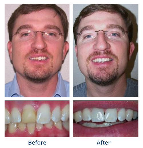 Before-and-after smile gallery case 7 with full-face and close-up smile photos