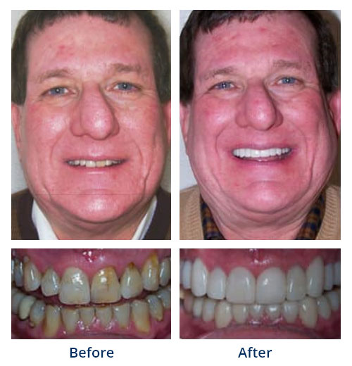 Before-and-after smile gallery case 2 with full-face and close-up smile photos